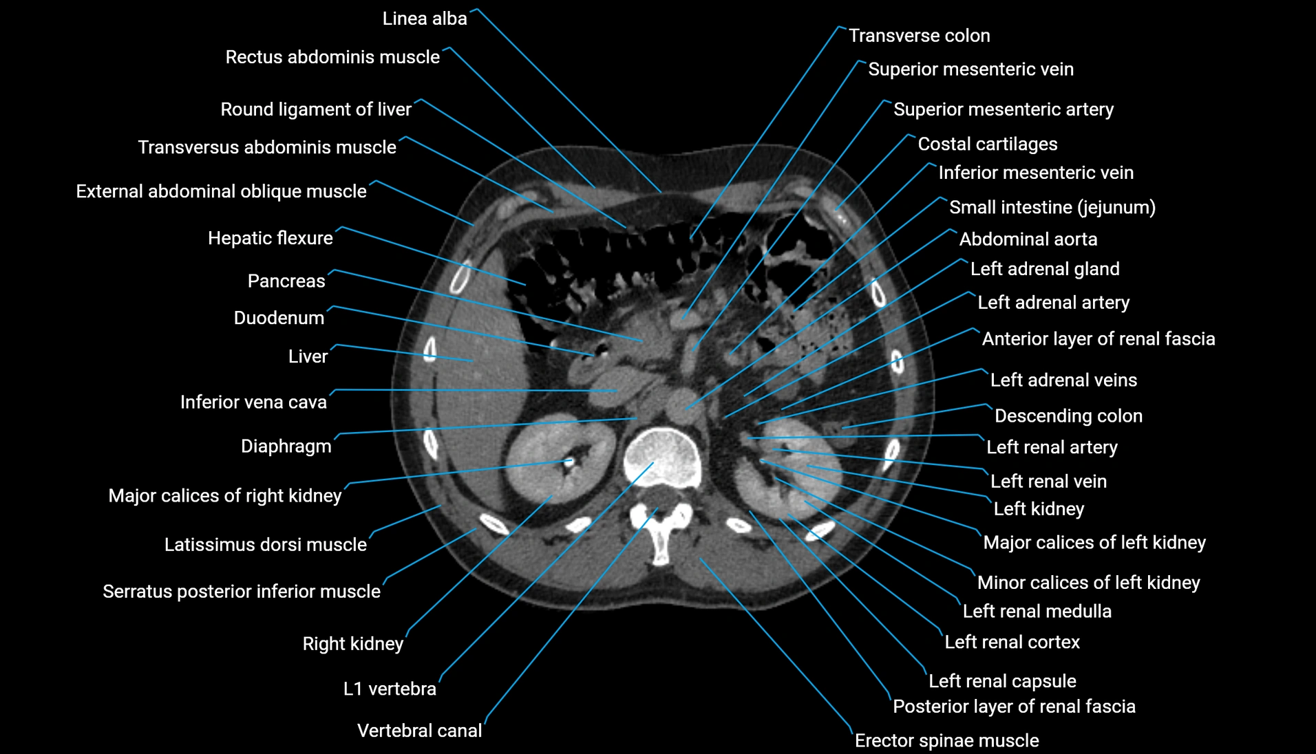 CT urogram axial cross sectional anatomy  labelled radiology image-00091.webp
